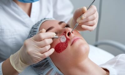 New blackhead removal videos